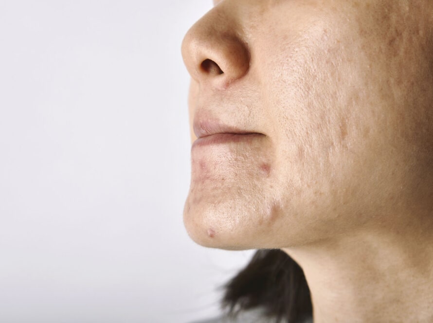 Skin problem with acne diseases, Close up of asian woman